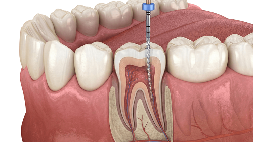 Teeth Whitening